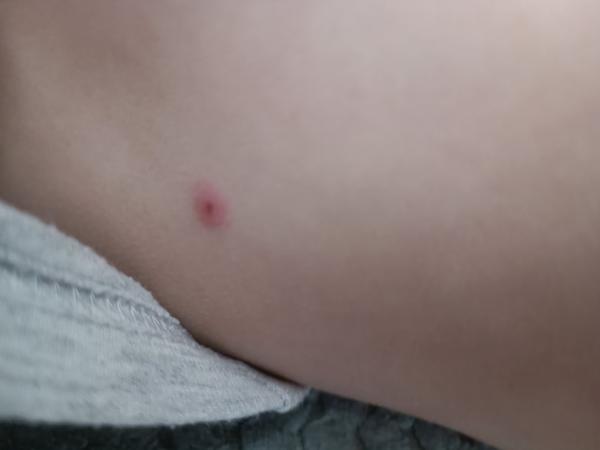 Jsou tyto pupínky příznakem neštovic?