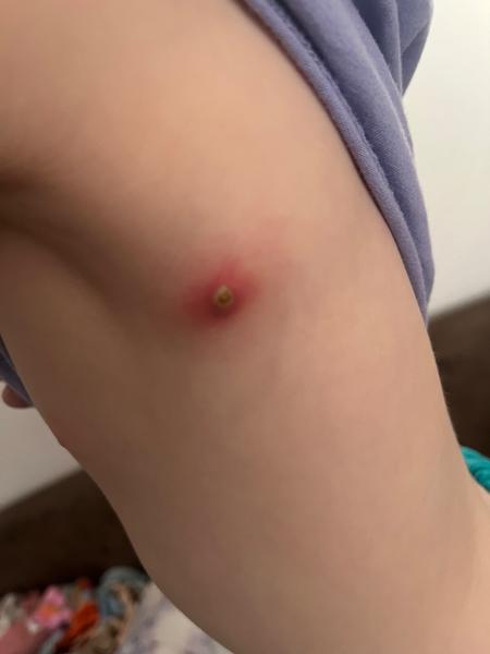 Léčba hnisavého pupínku u dítěte. Zkušenosti a rady?