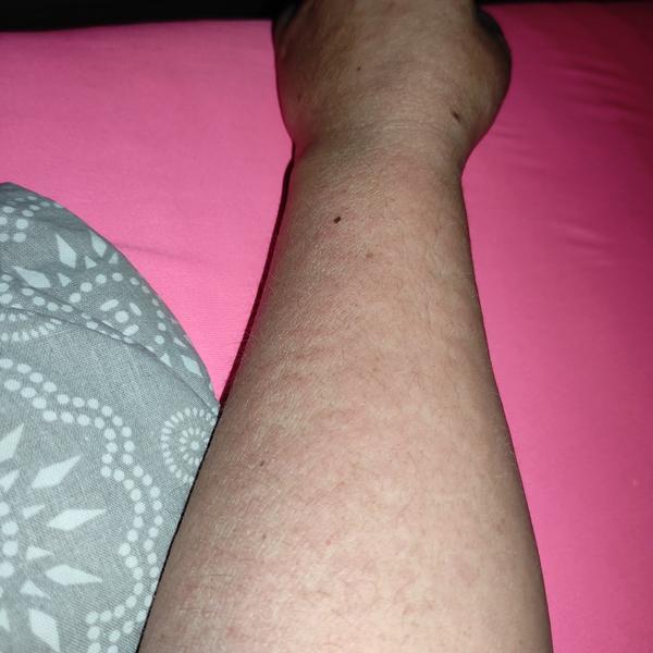 Může mít dospělý pátou nemoc? Zkušenosti a příznaky