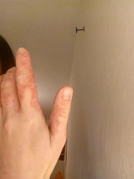 Jak vhodně léčit ekzém na rukou po porodu?