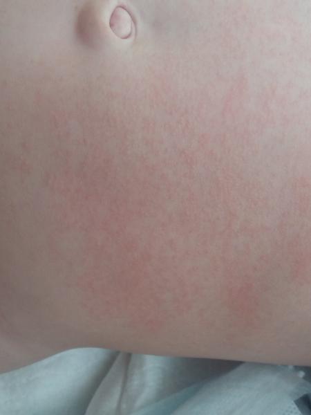 Vyrážka - "drsný" na dotyk a nesvědí