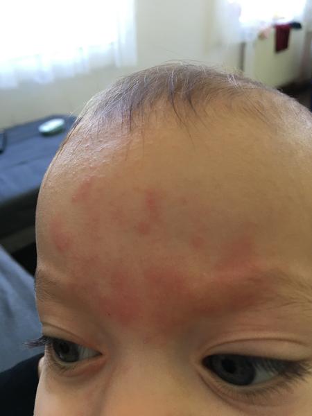 Krupičková vyrážka. Co by to mohlo být? Čím mazat?