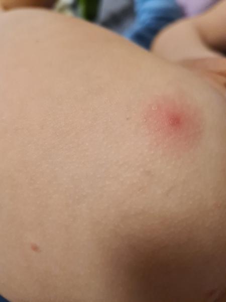 Co by to mohlo být za vyrážku?