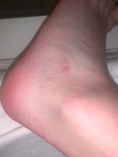 Jak rozpoznat svrab: zkušenosti a rady pro rodiny?