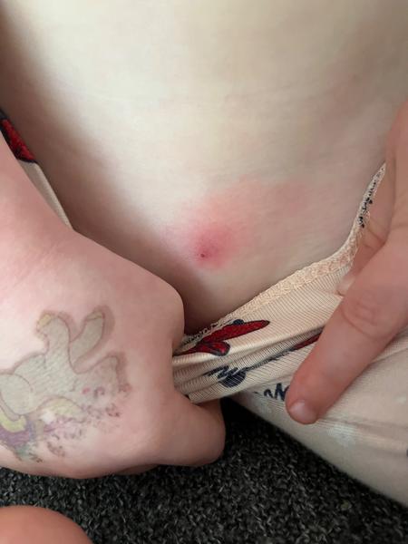 Pupínek na intimních partiích u dítěte. Jaké jsou příčiny?