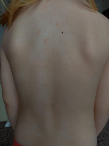 Fleky na těle u dcery. Co může být příčinou?