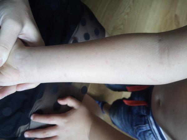 Mohou to být pupínky ze slunce?