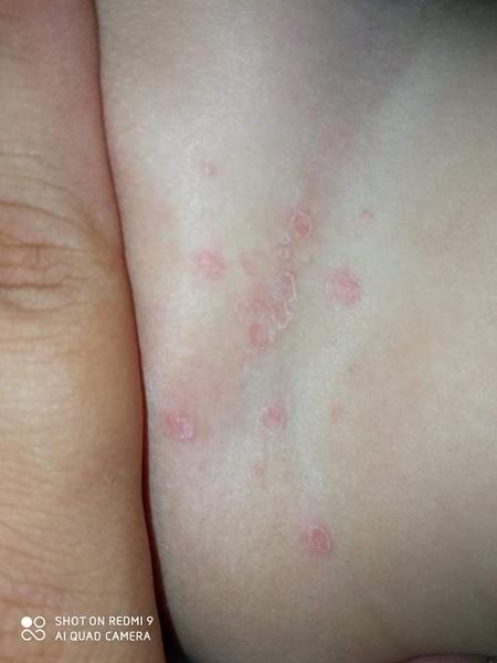 Flíčky u ročního dítěte. Co to může být?