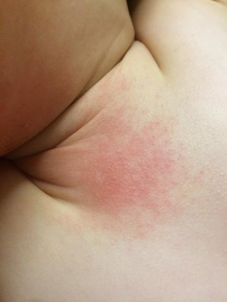 Máte s takovou podrážděnou kůží/exémem/alergií zkušenost?