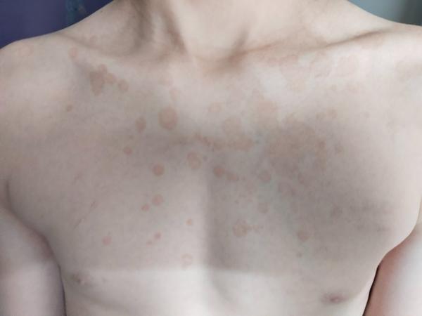 Fleky na hrudníku. Co mohou znamenat?