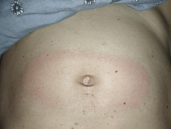 Je to erythema migrans nebo kvasinková infekce?