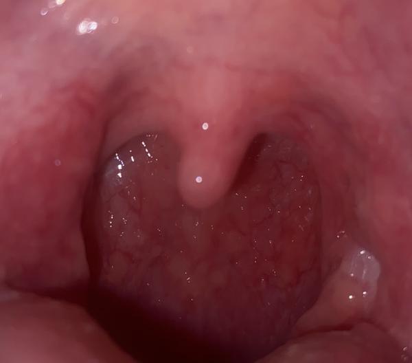 Co způsobuje červený krk bez bolesti?