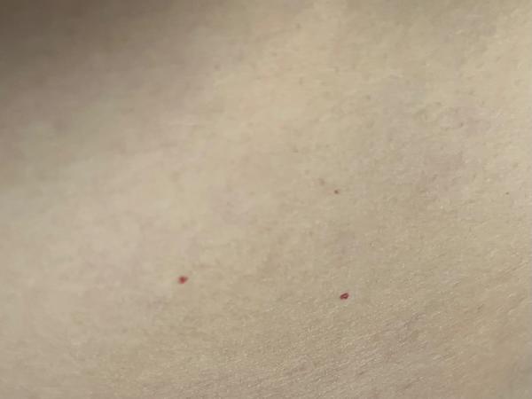 Červené tečky na kůži. Jsou to petechie nebo hemangiom?