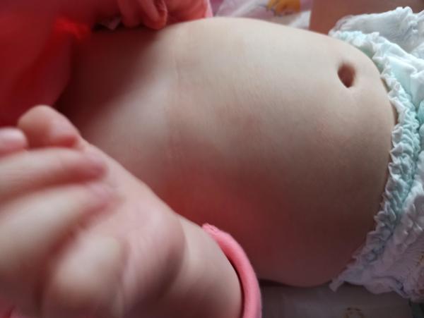 Krupička na bříšku u miminka. Jaké jsou příčiny a řešení?