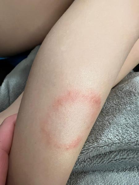 Flek na noze u dětí: Může jít o boreliózu?