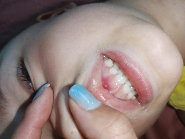 Co znamená zánět nebo váček v ústech?