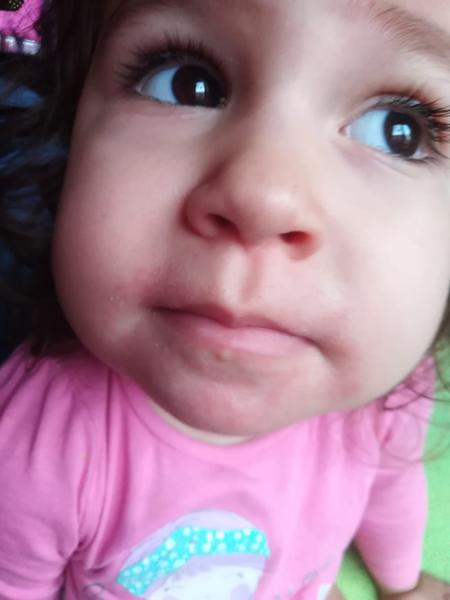 Vyrážka u pusinky po rajčeti. Může to bý alergie?