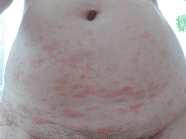 Jak se zbavit vyrážky pytrisia rosea?