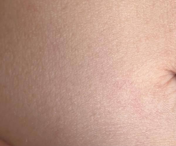 Červené fleky na břiše. Jak řešit jejich příčinu?