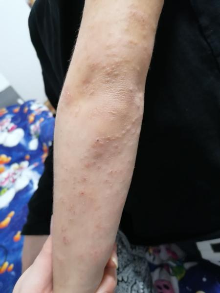 Může kiwi způsobit vyrážku u dětí?