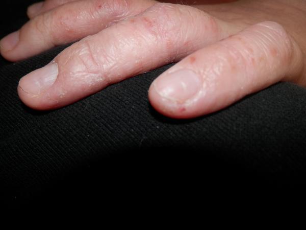 Zvlnění nehtů, může to být po gelových nehtech?