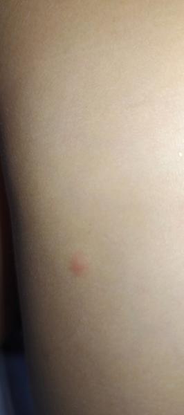 Pupínky na zádech u dítěte: Co to může znamenat?