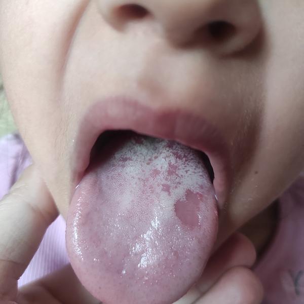 Je moučnivka důvod, proč držet dítě doma ze školky?