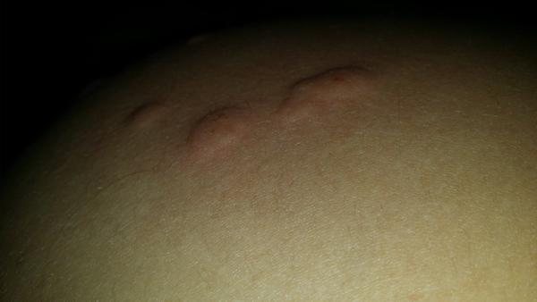 Bolí mě svaly, kosti, klouby a mám puchejřky. Co to je?