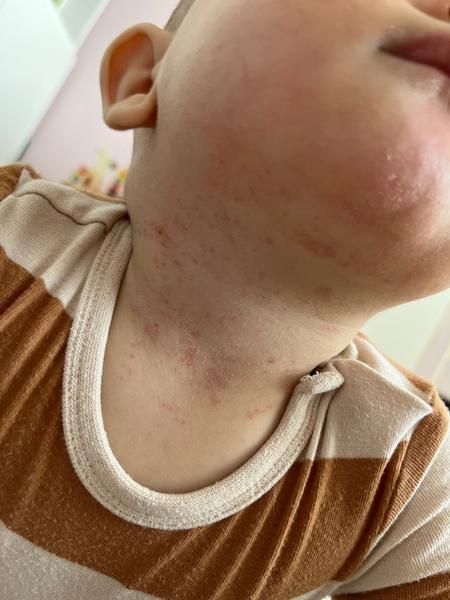 Co je to za vyrážku?