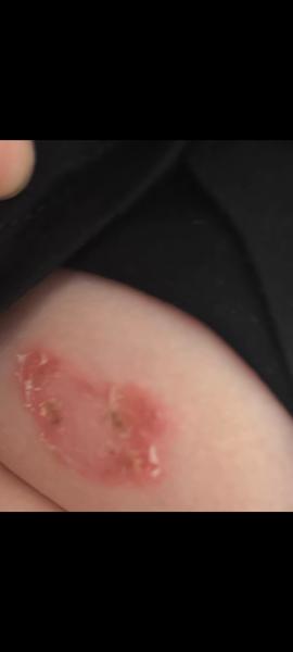 Infekce kůže bez zlepšení. Je nutná pohotovostní návštěva?