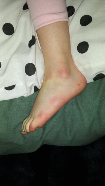 Alergie na Erythromycin u dcery? Zkušenosti a radu prosím!