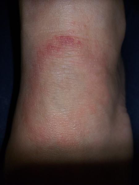 Červený flek na nártu. Borelióza, mykóza nebo něco jiného?