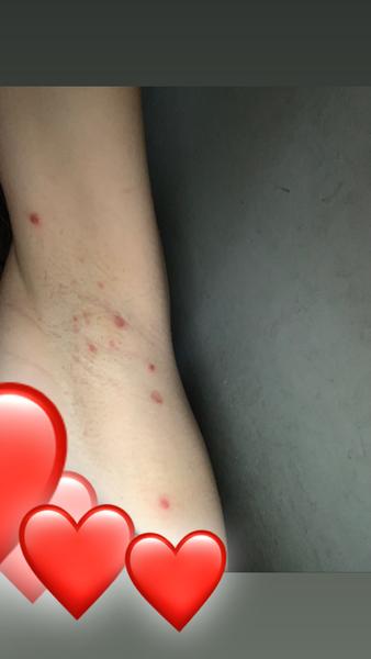 Vyrážka nebo pohlavní nemoc?