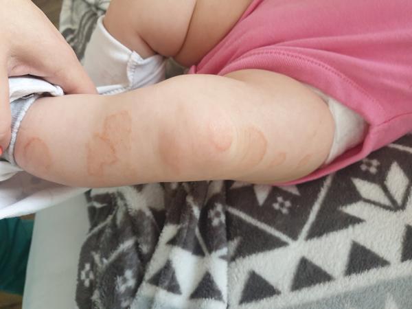 O jakou vyrážku se může jednat?