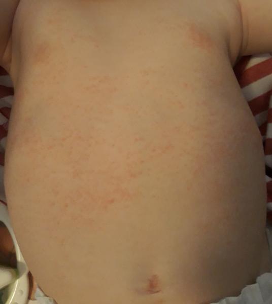 Atopický ekzém u dětí. Objevuje se a mizí. Typická místa pro ekzém jsou ale vždy čistá.