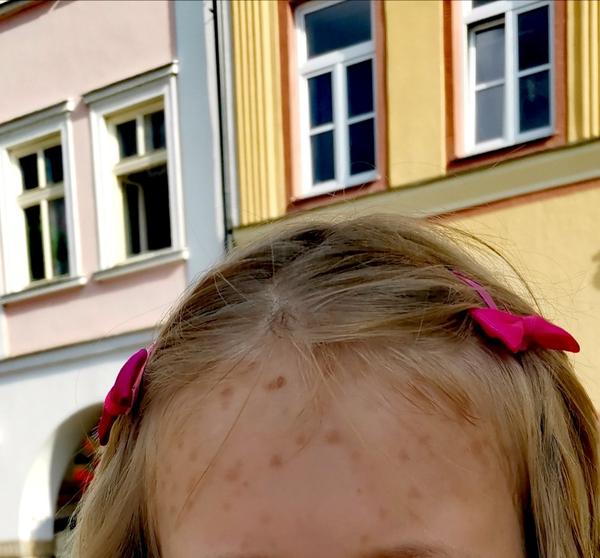 Pigmentová kopřivka u dětí: Jak ji léčit?