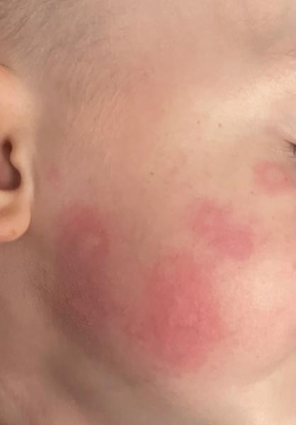 Zkušenosti s fleky na tváři u pětiletého dítěte?