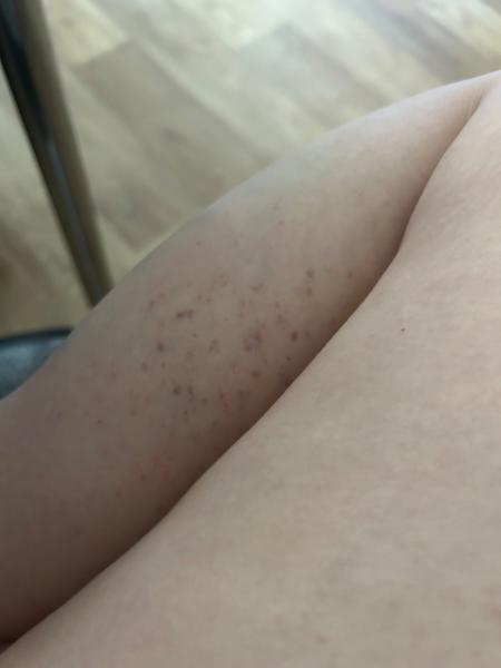 Nevíte, co způsobuje fialové svědivé pupínky na nohou?