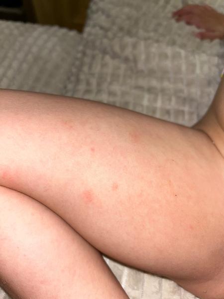 Locoid na atopický ekzém. Je to správné řešení?