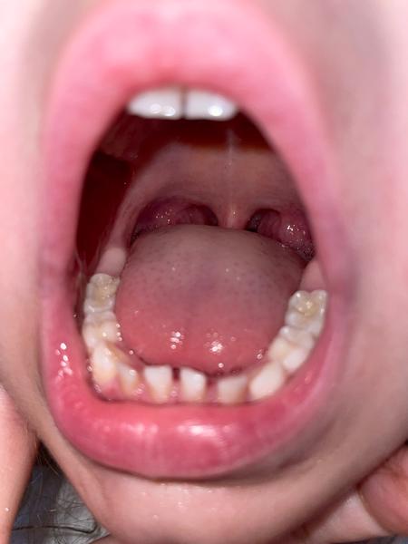 Mohou čtyřletému dítěti růst šestky?