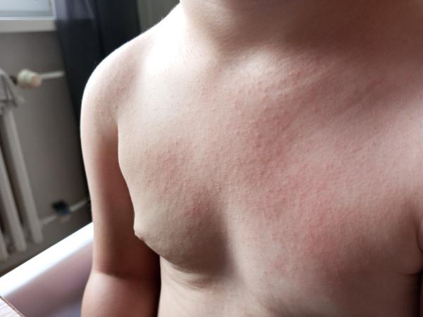 Neznámé tečky na těle dítěte: Jak řešit?