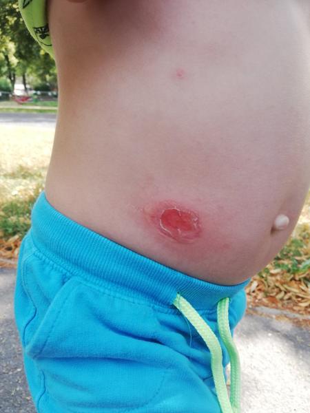 Impetigo - může to být?
