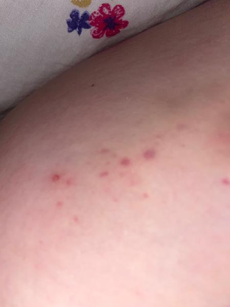 Svědění na těle. Může to být svrab?