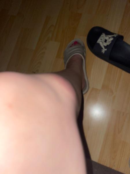 Kdy je nutné navštívit lékaře po štípnutí hmyzem?