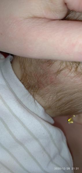 Neštovice. Mohly by to být?