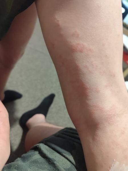 Ekzém nebo alergická reakce u dětí? Co způsobuje svědění?