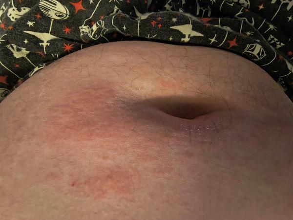 Vyrážka u dospívajícího syna. Může to být svrab?