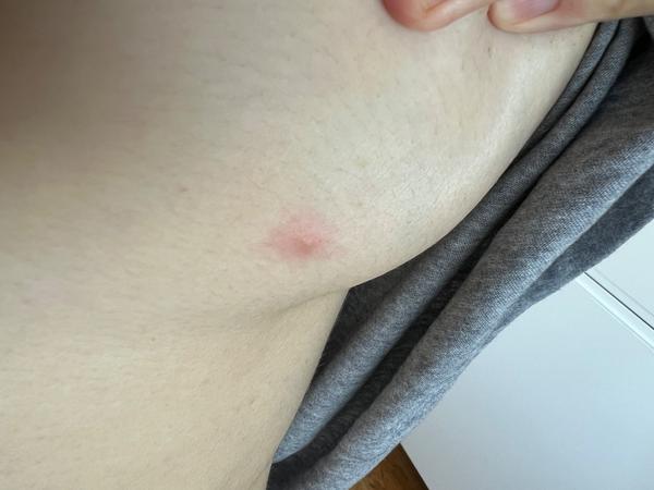 Mohou být pupínky příznakem neštovic během těhotenství?