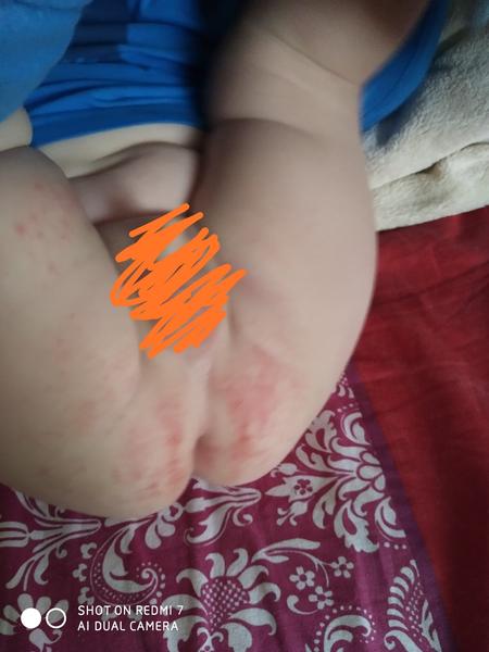 Průjem už týden. Co by to mohlo být?