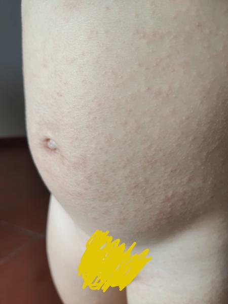 Ekzém? Jak prosím postupovat?